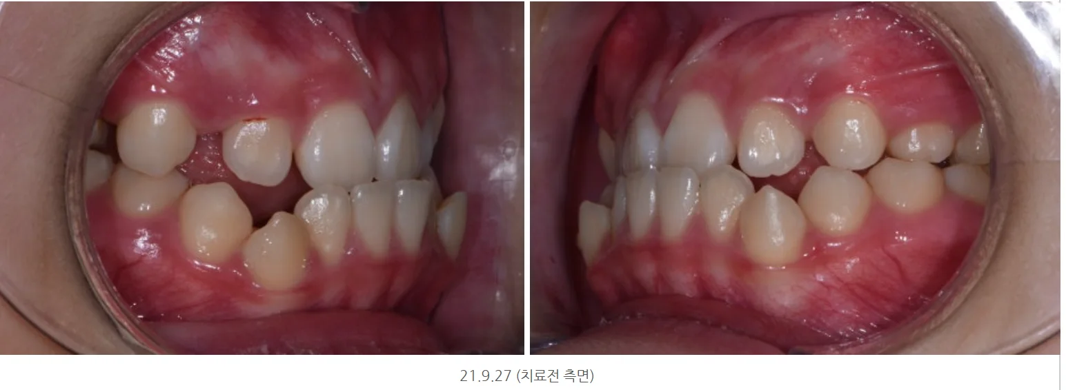 치료 전 측면 · 2021.09.27
