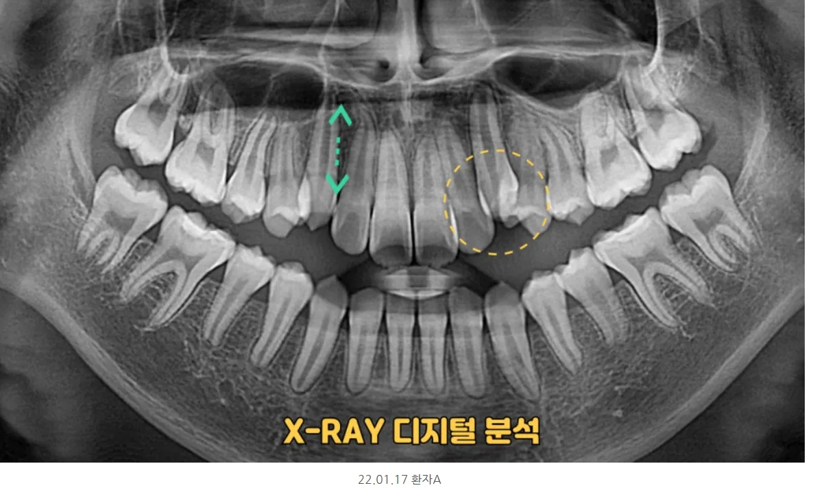 X-RAY 디지털 분석 – 뿌리 길이와 충치 여부 확인 (22.01.17)