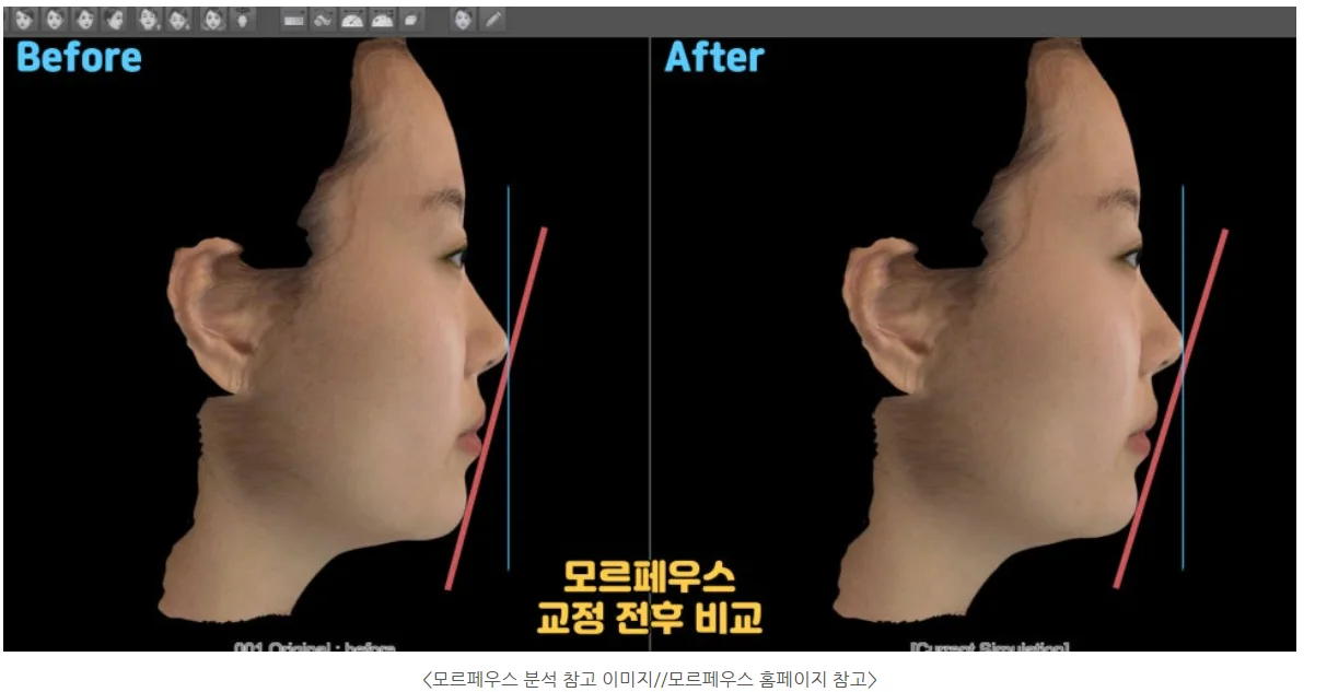 모르페우스 교정 전후 옆모습 시뮬레이션 (모르페우스 홈페이지 참고 이미지)