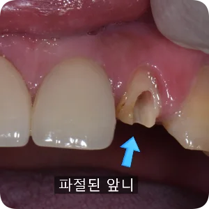 2023.03.17 치료 전 구강 사진: 심하게 파절된 앞니