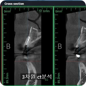 2023.03.17 3차원 CT를 통한 치근과 주변 조직 분석