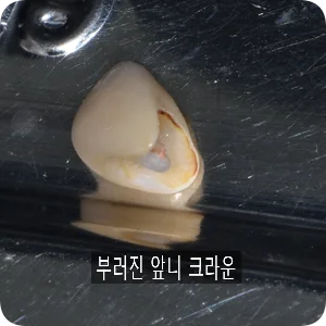 2023.03.17 제거한 부러진 앞니 크라운의 내부 모습