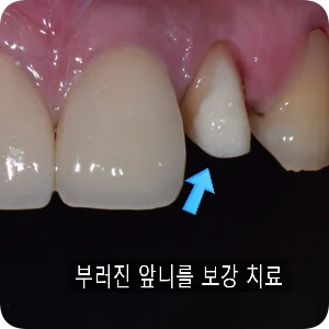 2023.03.27 탄소섬유 포스트와 레진으로 부러진 앞니를 보강한 모습