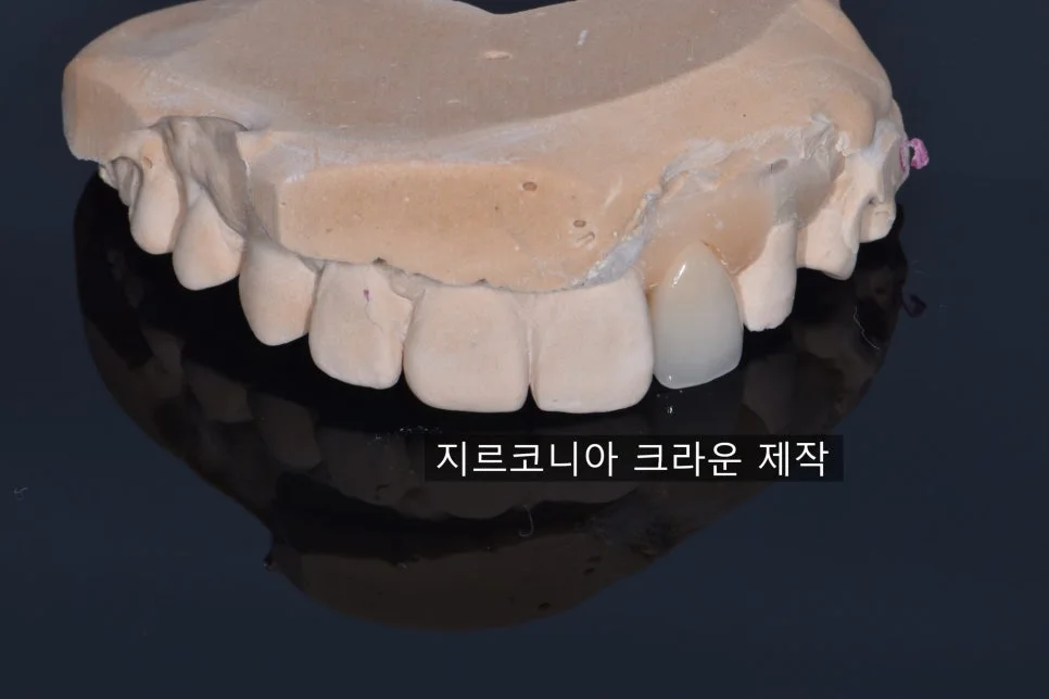 2023.03.27 앞니 형태와 색조를 고려해 제작한 지르코니아 크라운