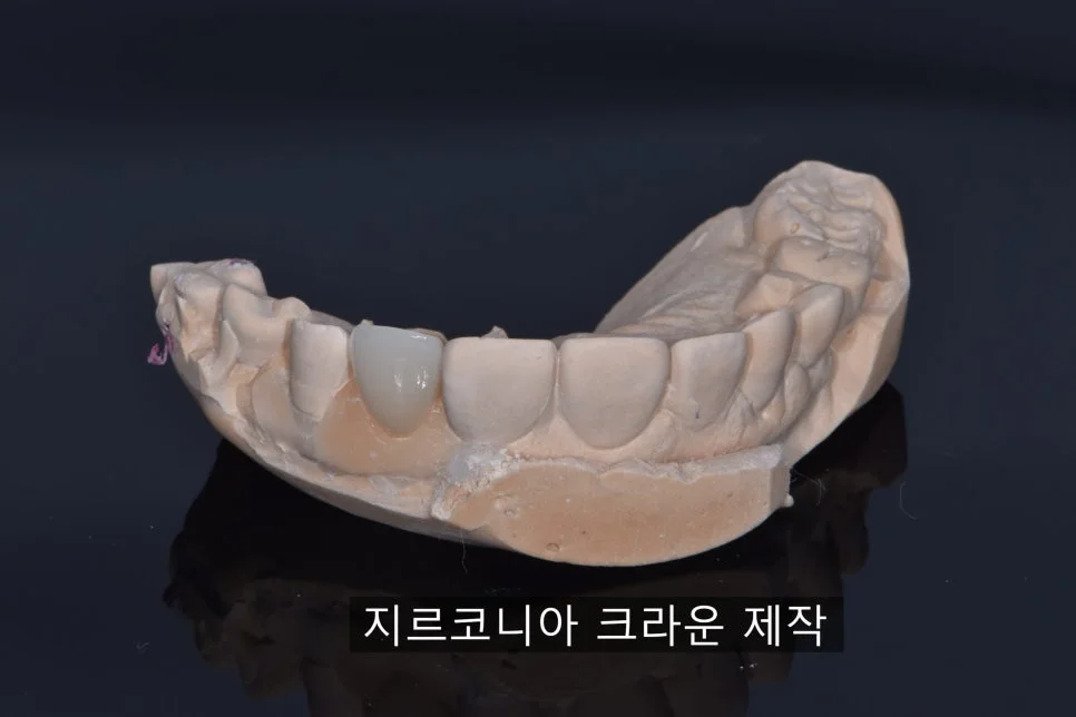 2023.03.27 구강 내 적용을 위해 제작한 지르코니아 크라운