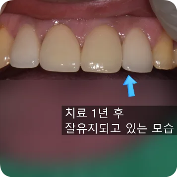 2024.10.31 치료 약 1년 7개월 후 구강 사진 경과