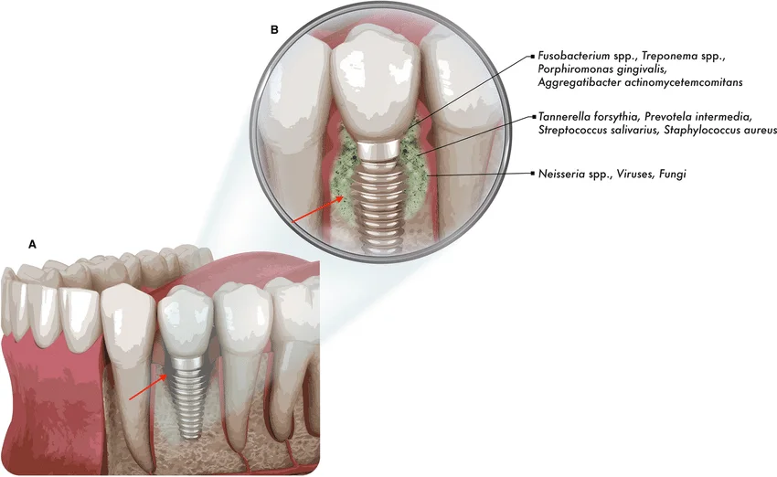 출처 Derks A, Tomasi C. Peri-implant health and disease — A systematic review of current epidemiology.