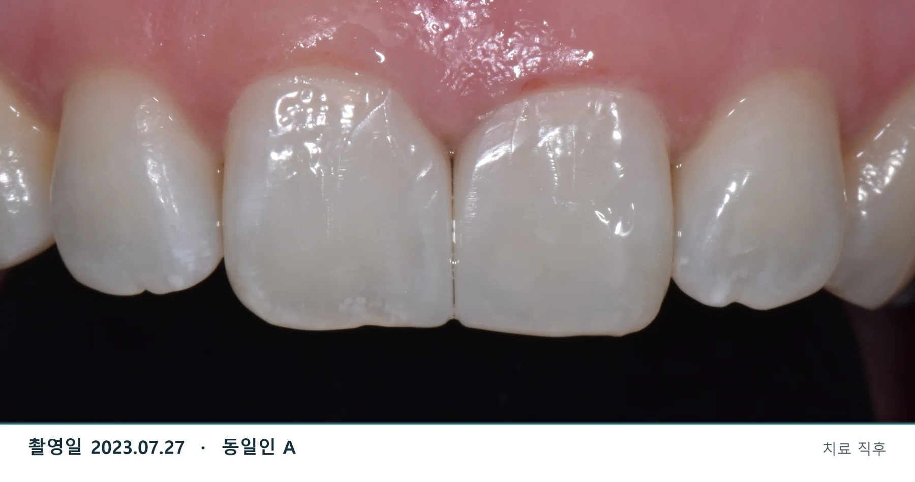 2023년 7월 27일 심미레진 치료 직후 · 동일인 A