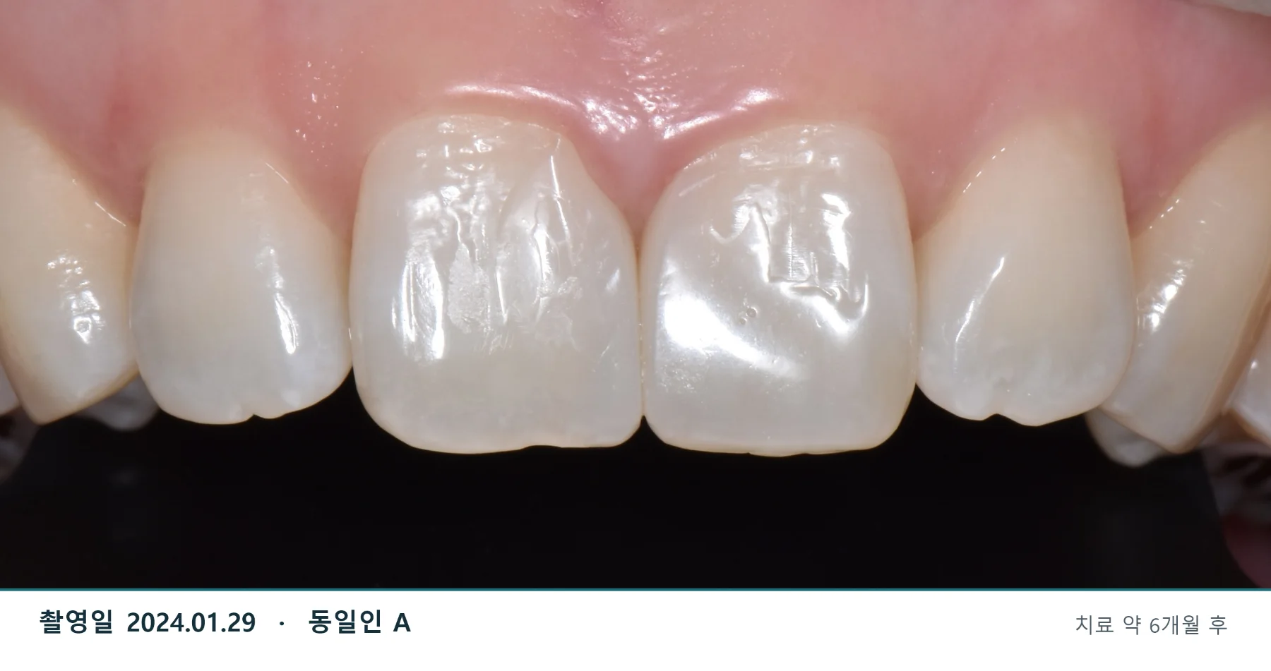 2024년 1월 29일 치료 약 6개월 후 정기검진 · 동일인 A
