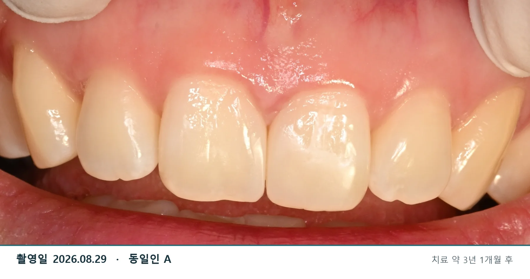 2026년 8월 29일 치료 약 3년 1개월 후 정기검진 · 동일인 A
